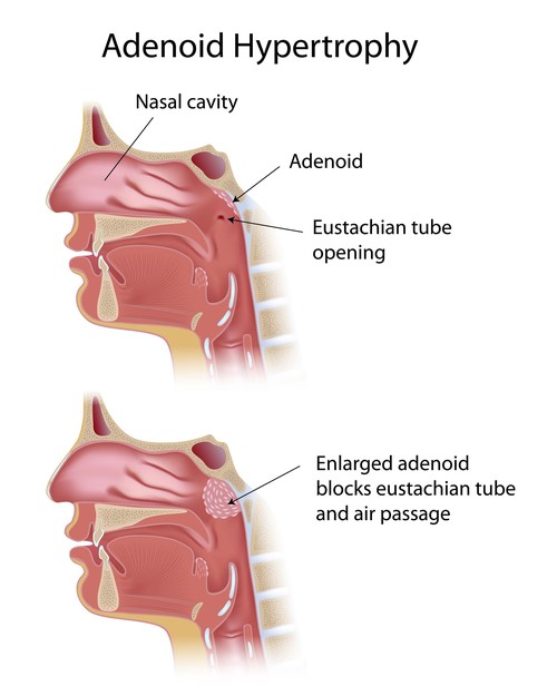 Adenoids