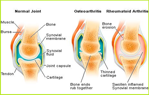 Arthritis