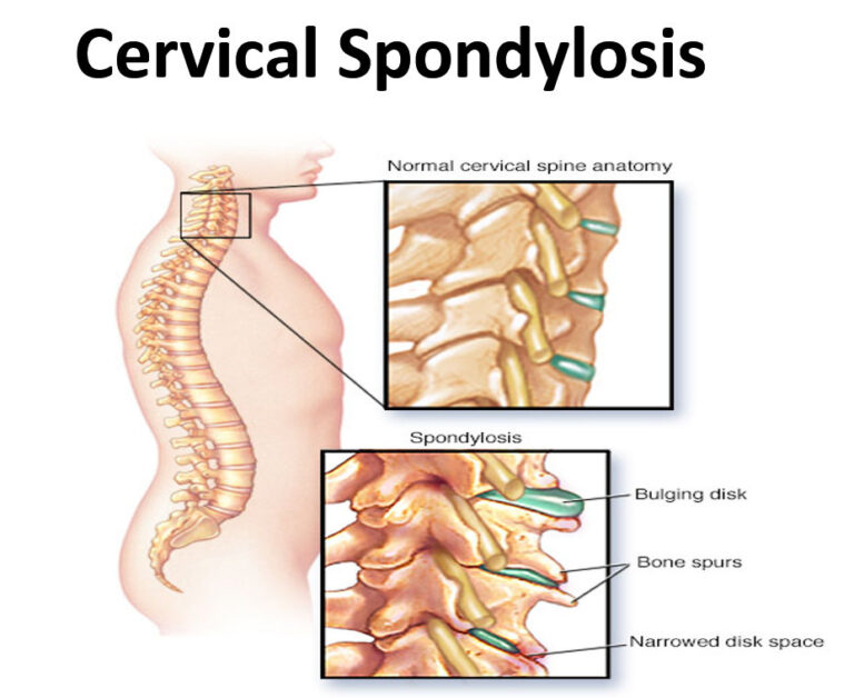 Cervical Spondylitis