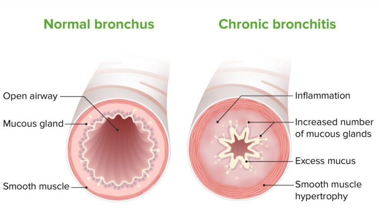 Bronchitis