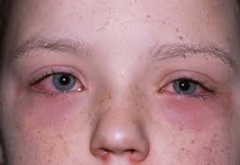 Conjunctivitis