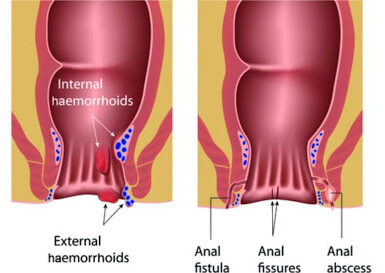 Fistula