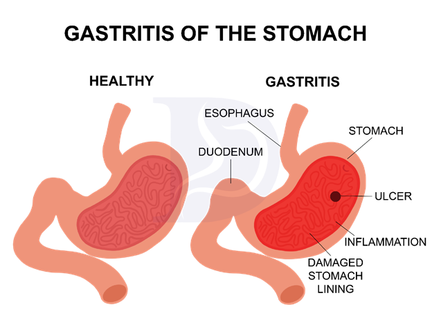 Gastritis