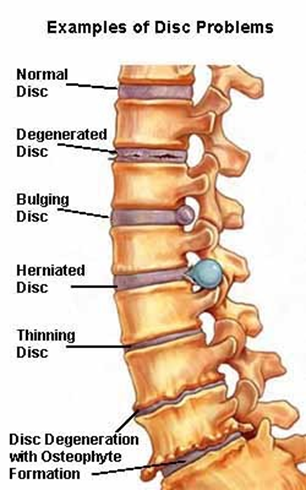 Lumbar Spondylitis