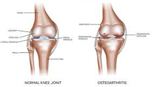 Osteoarthritis