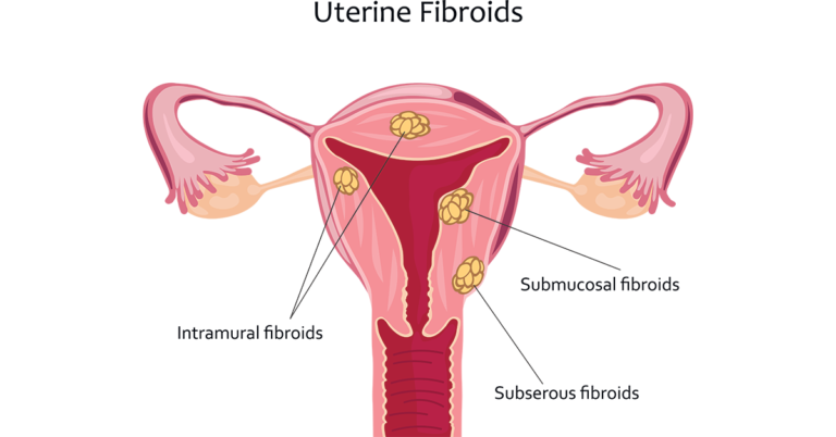 Fibroids