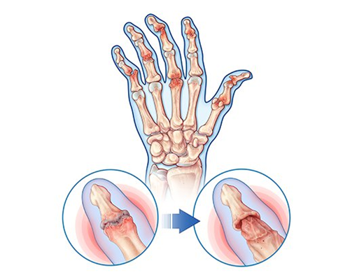 Psoriatic Arthritis