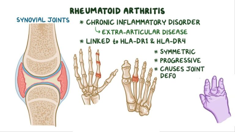 Rheumatoid Arthritis