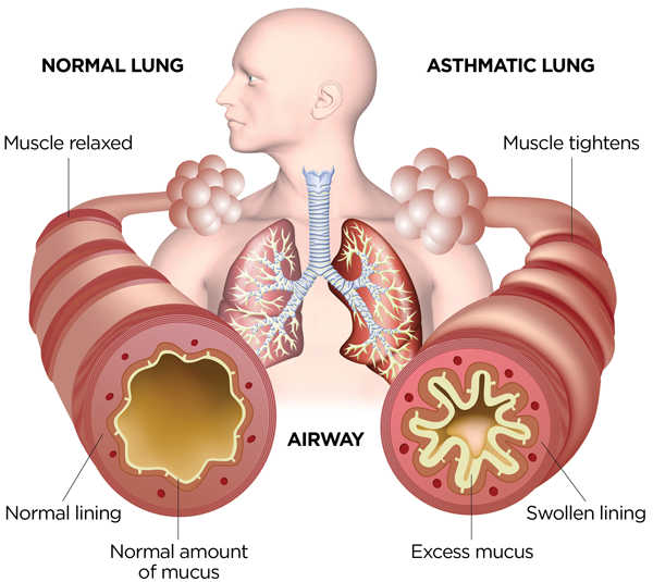 Asthma