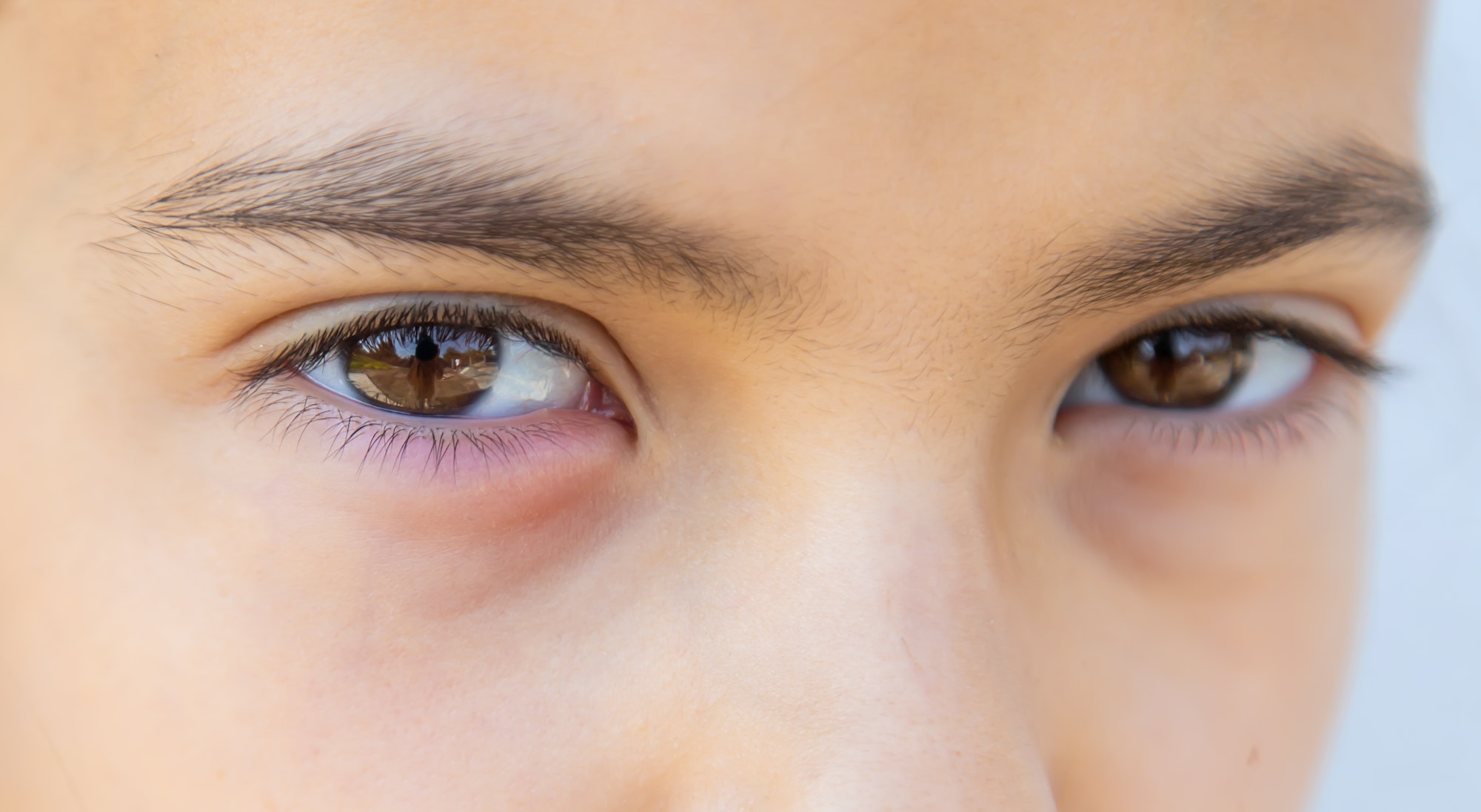 The child eye is inflamed. Selective focus.